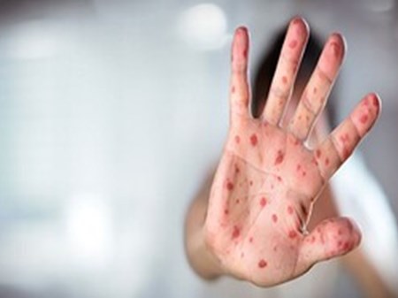 معاون بهداشت دانشگاه جندی شاپور مطرح کرد: افزایش موارد ابتلا به سرخک در خوزستان در ماه‌های اخیر